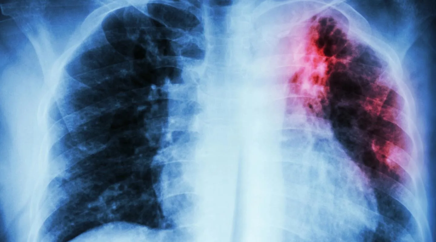 Заболеваемость туберкулезом возросла в ряде российских регионов